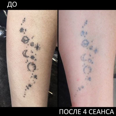 Лазерное удаление татуировок и перманентного макияжа