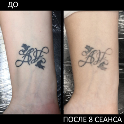 Лазерное удаление татуировок и перманентного макияжа